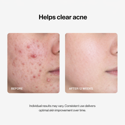 Slayitco 24H Acne & Pimple Serum