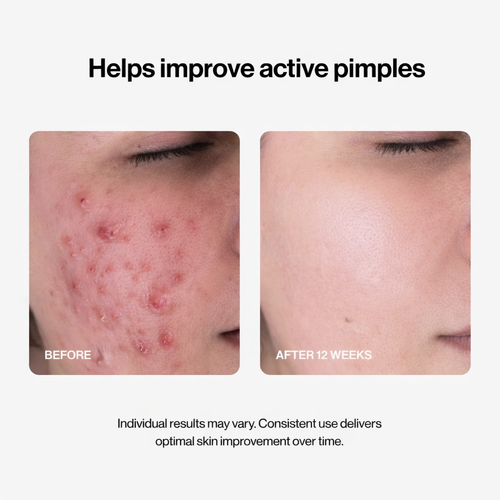 Slayitco 24H Acne & Pimple Serum