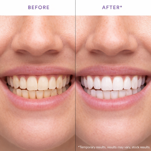 Slayitco™ Purple Whitening Strips